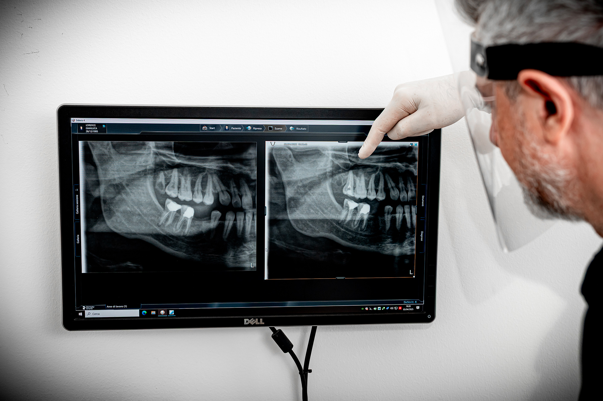 rx-prima-e-dopo-endodonzia