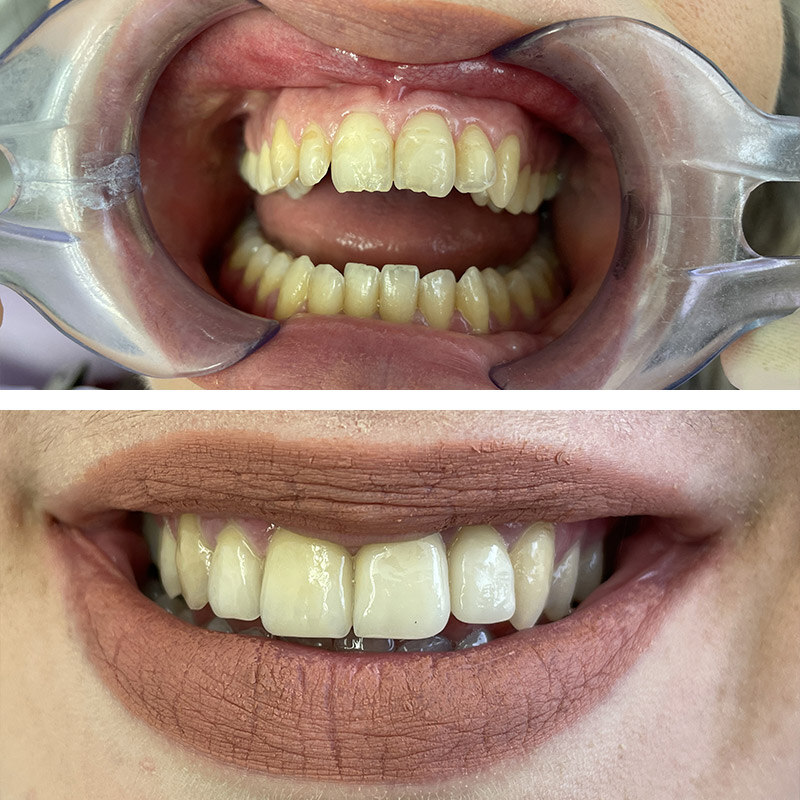 pre-post_faccette